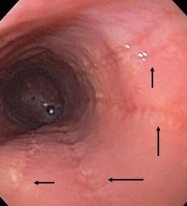 Esophageal GI Photo Gallery