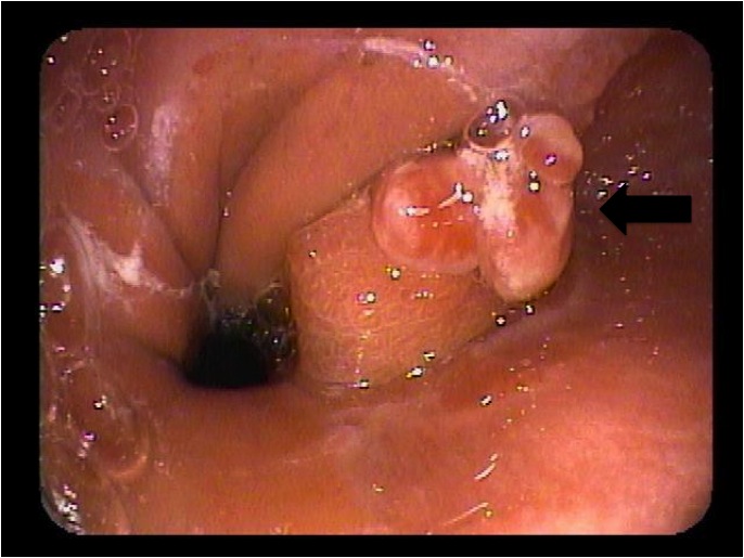 Distal Esophageal Polyp