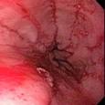 Esophageal Crohn's disease