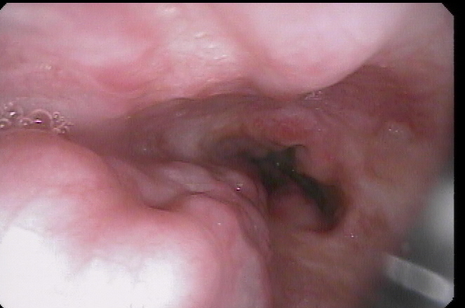 Esophageal Varices