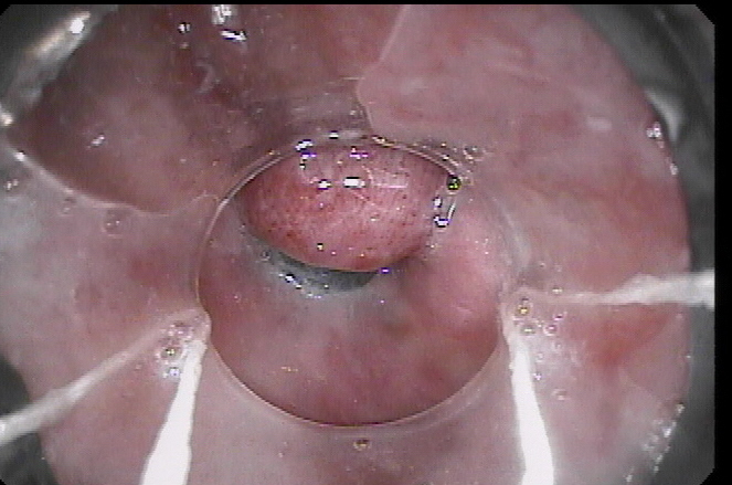 Esophageal varix after band ligation