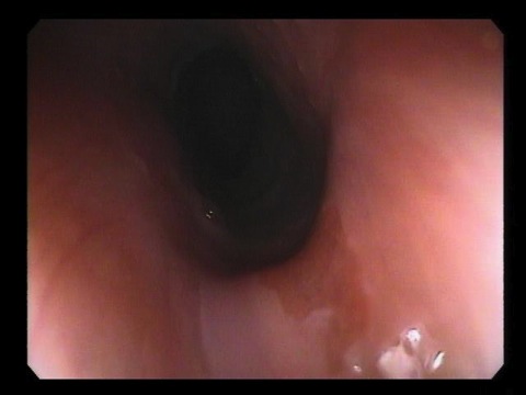 Gastric Inlet Patch