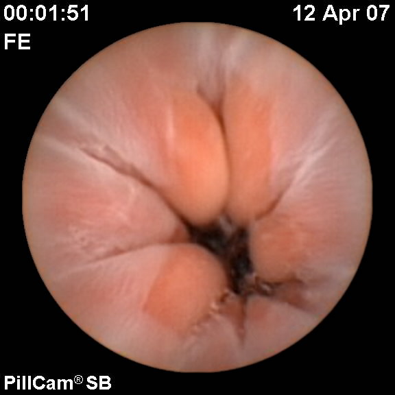 Normal Gastroesophageal Junction